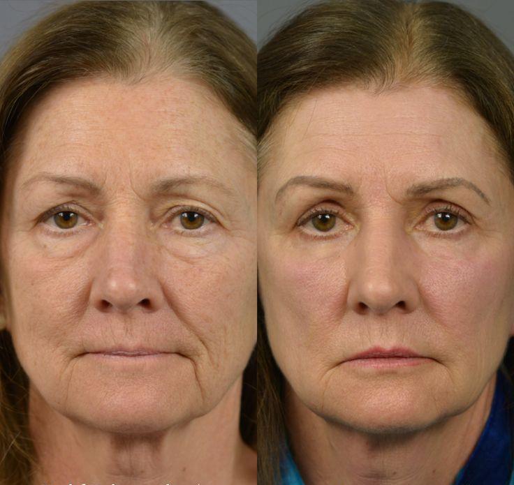 Original face before-and-after photographs